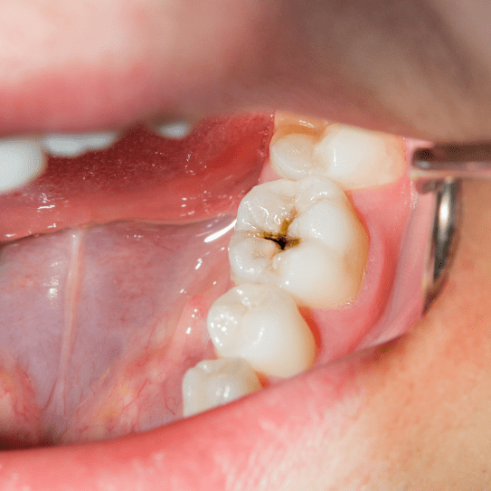 cavity treatment in apollo beach