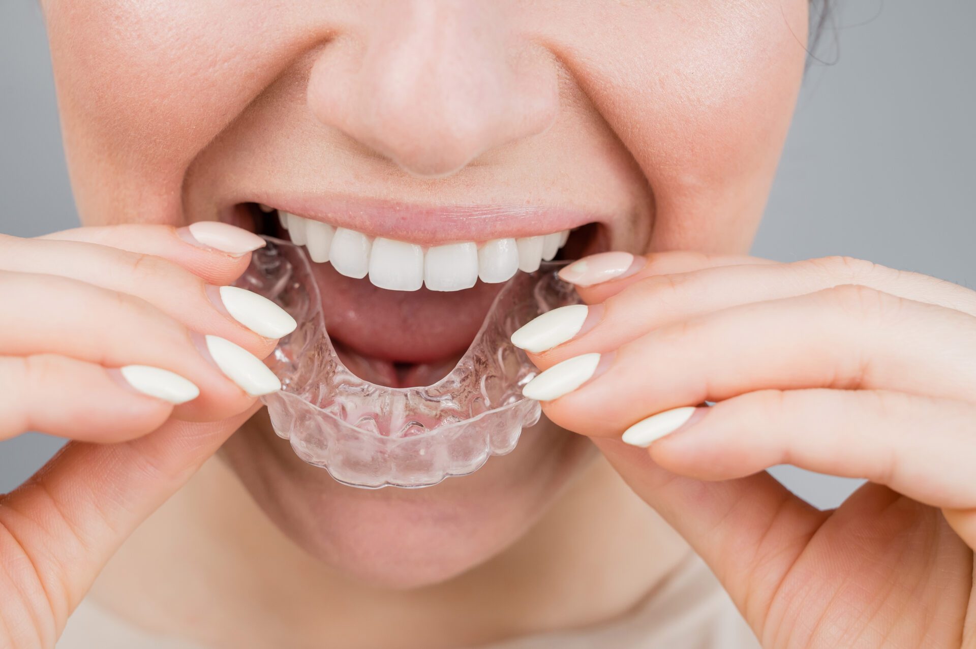 Invisalign in Apollo Beach
